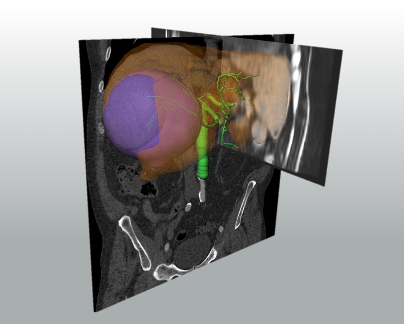 Multi-modal image registration for selective internal radiation therapy planning of the liver.