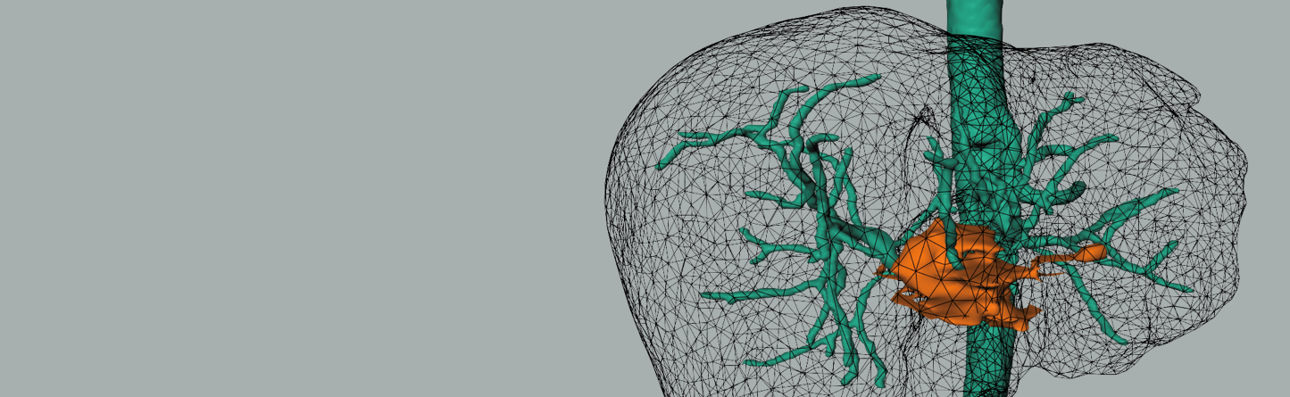 Liver with a tumor and hepatic artery segmentation.
